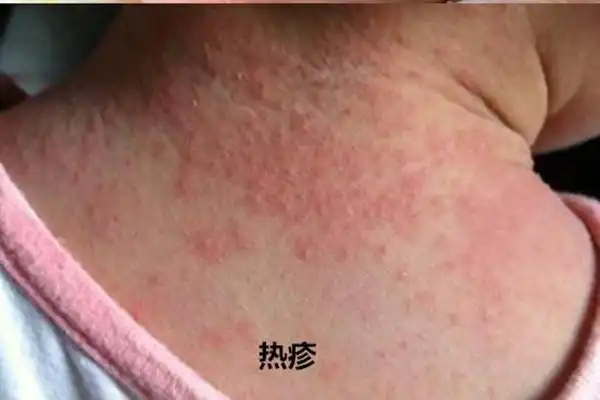 湿疹与热疹的区别图片一目了然别再傻傻分不清了