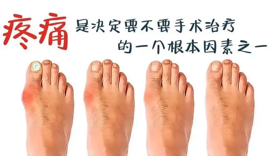 对于拇外翻的治疗方案除了考虑脚趾变形的程度,自己的疼痛度以及疼痛