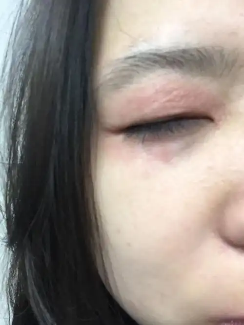 眼皮干燥发红不疼不痒