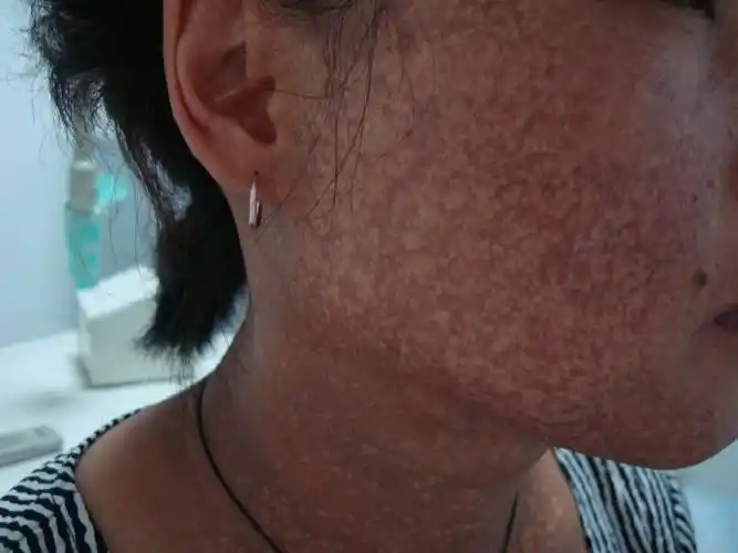 面颈部黑病变20年(带照片),请大家讨论诊治方案