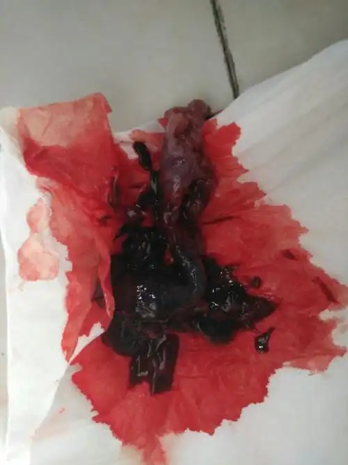 先兆流产好多天出血,还有很大的血块,去医院卵黄囊还在长~感觉好害怕