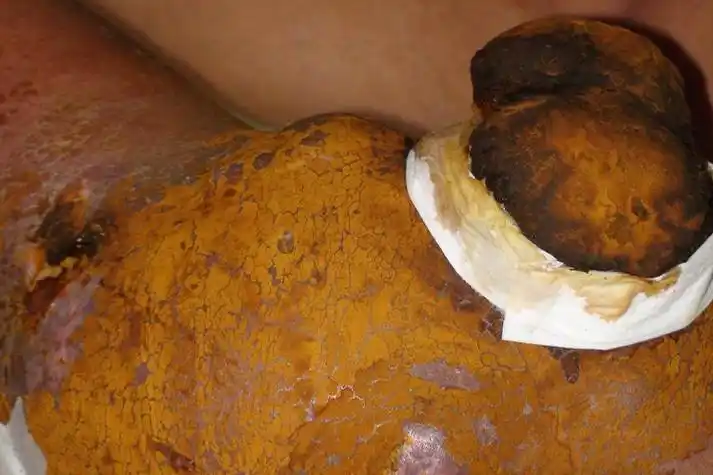 大腿根部长的肉瘤图片