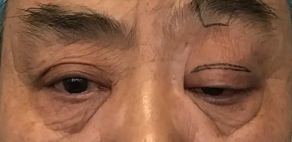 上睑下垂常见治疗方法