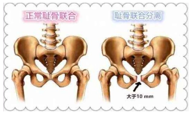 宋成宪提醒,如果产后妈妈出现大腿根部及骨盆周围的疼痛时,极有可能患