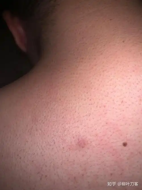 大家身上出现的那些小红点,那些最多的就是毛囊炎一类的疾病,跟hiv有