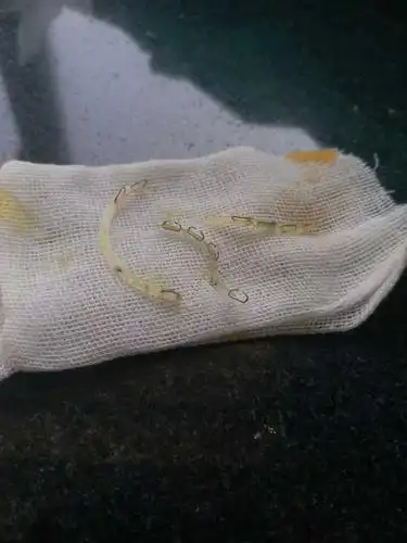 我把裤子脱了,医生看了一眼都头疼:我开了那么多手术就你这个纱布老是