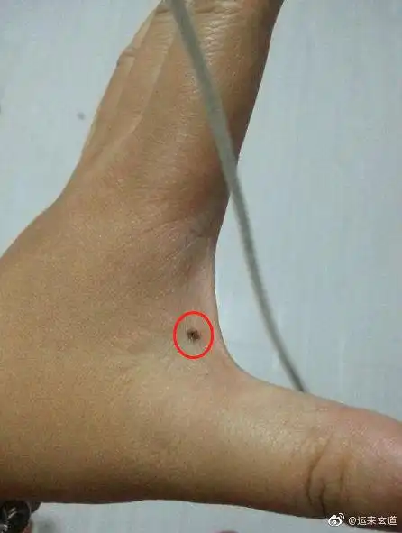 大家都知道掌心痣主富掌背主贵那么虎口这个部位长痣又代表什么呢