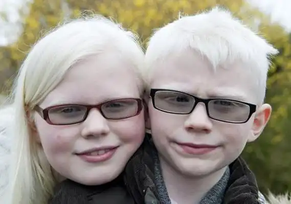 白化病尚不能治愈,是先天性皮肤病,对紫外线敏感,需要进行防晒