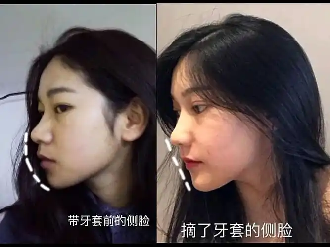 整牙对我的侧脸的改善夕今天翻出照片对比发现矫正之后_圈子-新氧美容