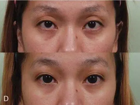 眼睛外凸怎么办填充脂肪或隆鼻都可以补救