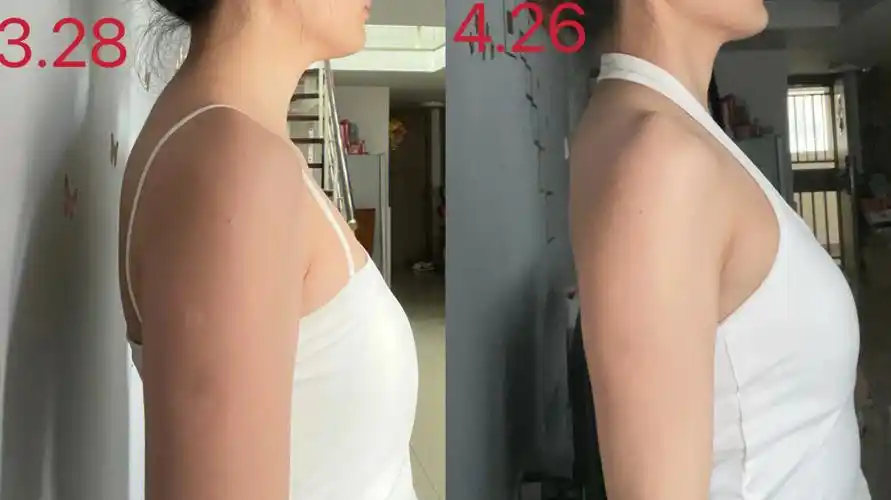 圆肩驼背头前伸锻炼一个月侧面对比