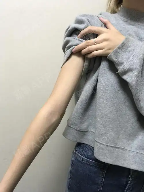 女大学生的手臂吸脂真实体验做完居然成了这样太遗憾了