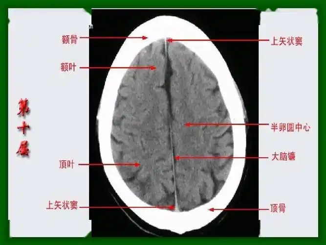 头颅ct 解剖图谱,人手一份