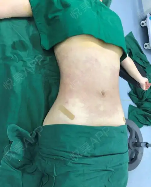 【美好尉来医美腰腹环吸术后第0天】我算是美好尉来的.