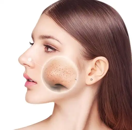 去黑头有哪些误区? 正确的祛除姿势是怎样的? - 简书