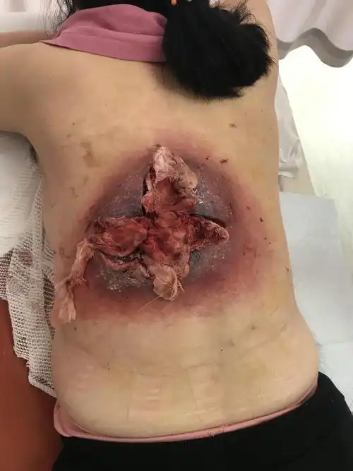 治疗背部巨大痈一例_痈_痈治疗方式 - 好大夫在线