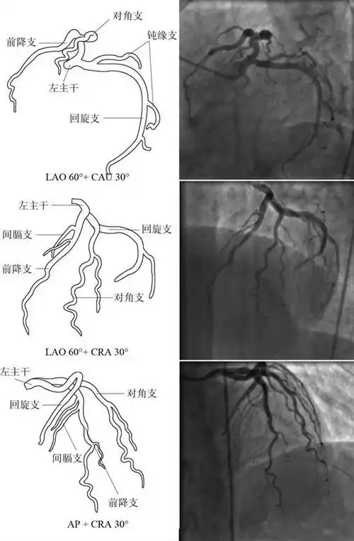 冠心病造影检查心肌梗塞,冠脉介入术是非常有效的重建冠状动脉灌注的