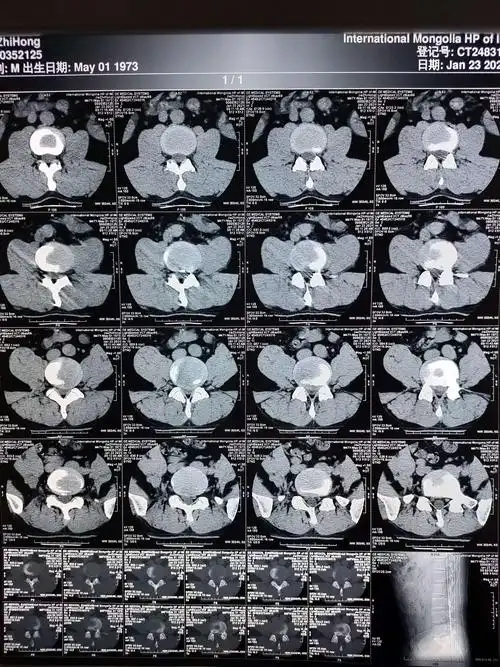 椎间孔镜技术——治疗腰椎间盘突出症