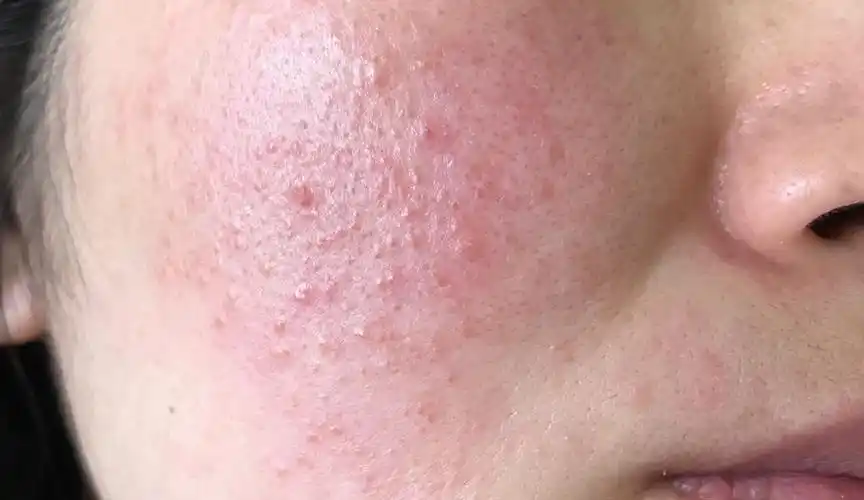 请问一下我这是过敏性皮炎吗?应该如何治疗?