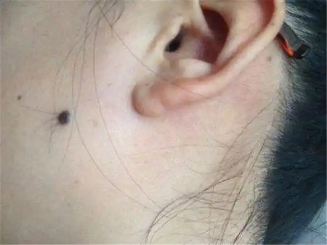 小孩黑痣图片_有来医生