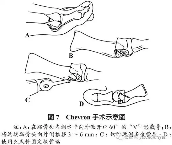 拇外翻诊疗专家共识