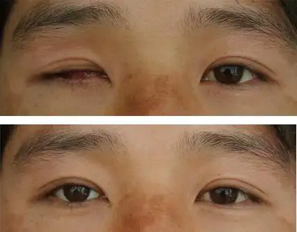 邢台哪里有安装假眼的