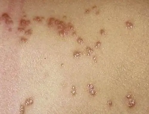 孕妇疥疮初期腹部皮肤症状图片