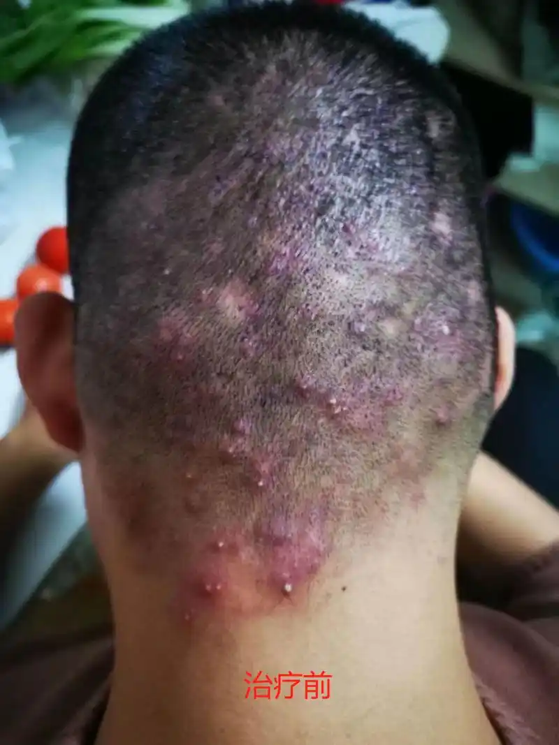 毛囊炎折磨好久了,后脑勺枕部位置反复长脓包疙瘩,炎症连带着整个头皮