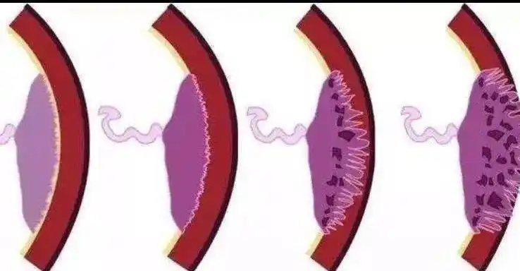 徐水妇幼61厚德精医我院成功实施胎盘植入剖宫产术
