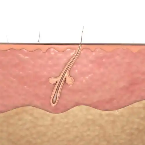 痤疮毛孔3d模型