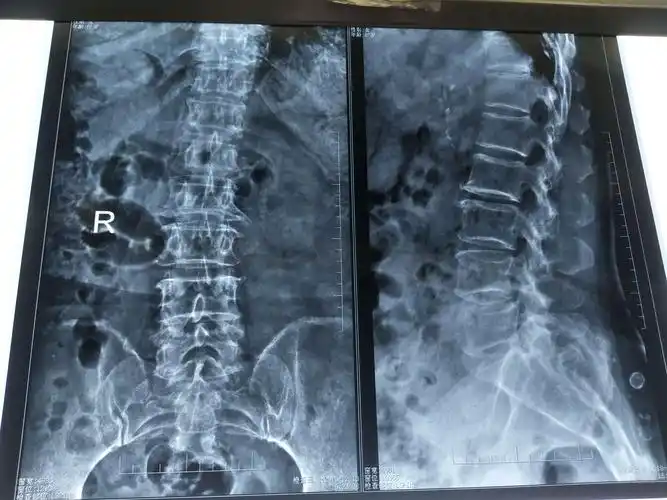 腰椎平片示:腰椎骨质增生