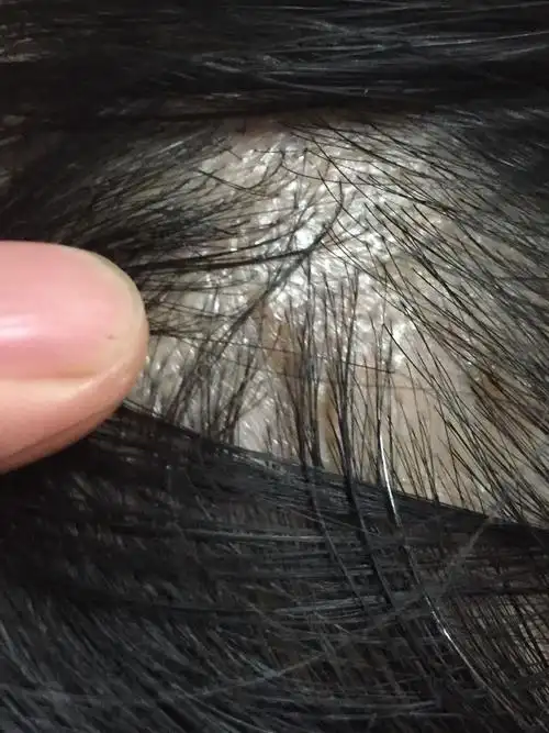 看到妈妈头皮上长了这个东西,没有什么病史,定期体检