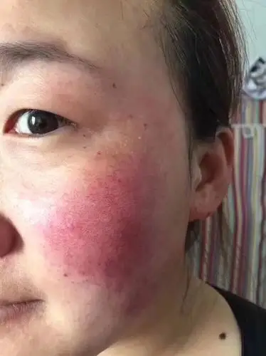 这样的蜕变,是不是很震撼红血丝,过敏,激素脸通通可以找我帮你