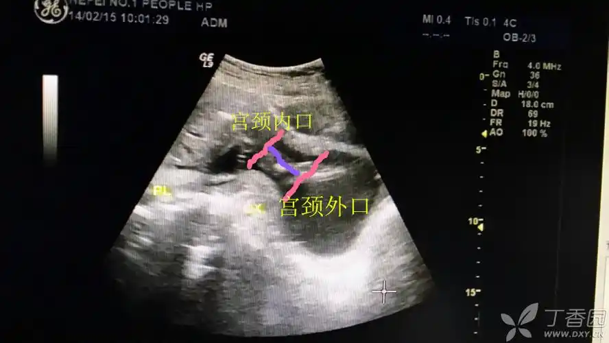 我试着帮你测量,紫线应该就是宫颈的长度