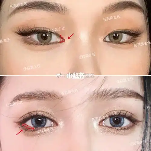 开眼角和眼睑下至一样吗?当然不一样!