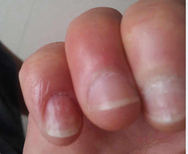 请问,指甲这样是真菌感染吗?急求!