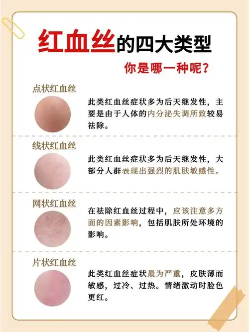 07点状红血丝,线状红血丝网状红血丝,片状红血丝如果你脸上也有红