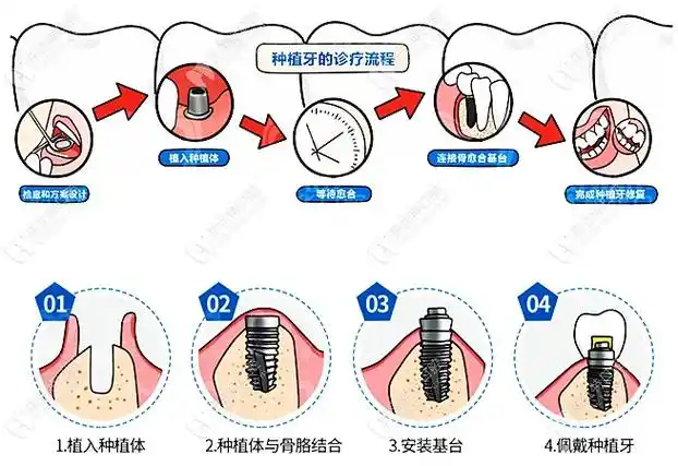 种植牙的诊疗流程图