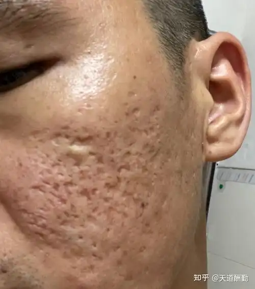 co60点阵激光,治疗10多年重度痘坑的经历!