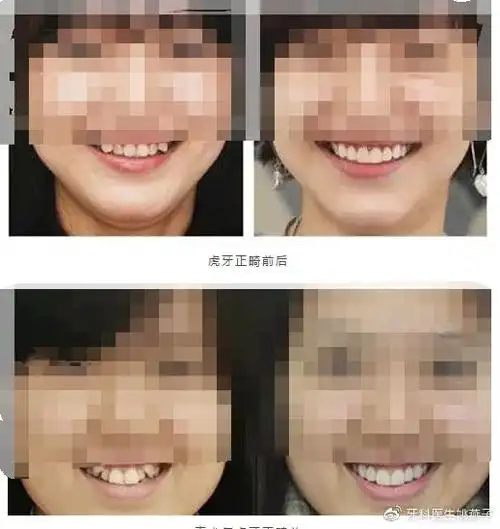 可爱的虎牙到底能不能拔?