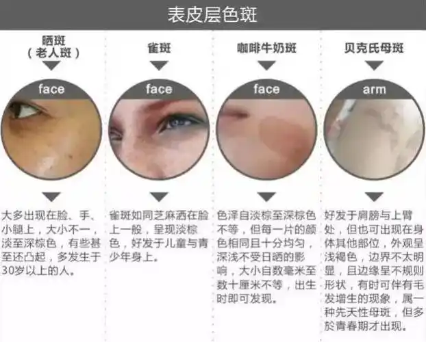 面部色斑,都是些什么斑?美丽不一斑