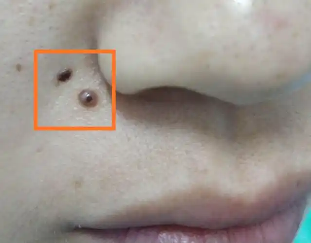 长痣正常,但痣有好坏,怎样的痣是"坏痣"呢,一但长了要警惕!