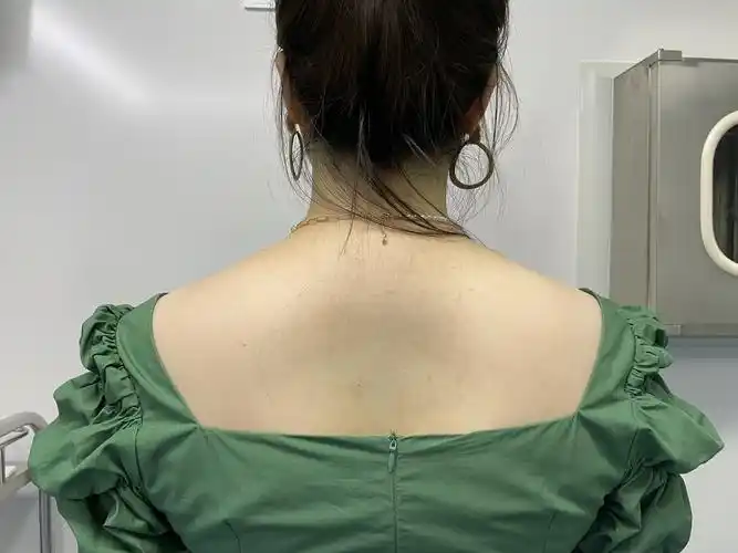 肩膀的斜方肌太发达了,显得脖子都变短了