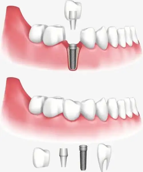 台心种植牙的寿命有多久