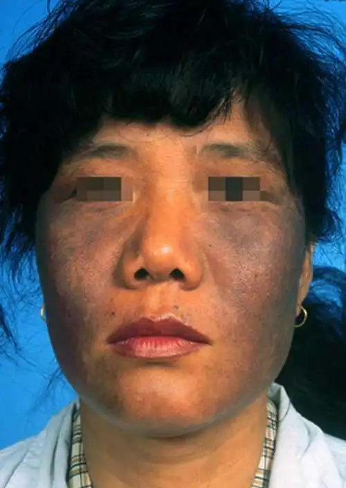 黑变病的主要症状表现是什么_黑变病症状_大成皮肤网