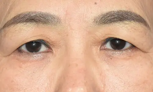 上眼皮多重褶皱,皮肤皱纹增多同时伴有上眼睑凹陷,外眼角明显松弛下垂