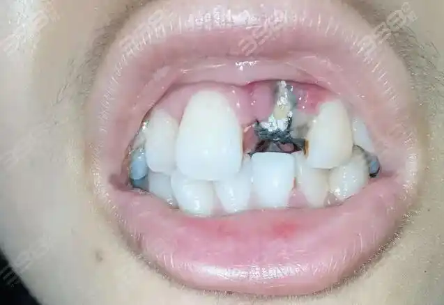 亲身经历40岁种植牙失败太痛苦了想问种植牙坏了还能二次种植吗