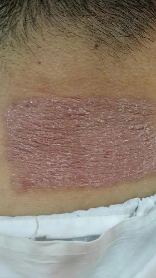 我贴膏药过敏了 已经一个礼拜了 是不是快好了呀 还用不用涂点药膏呢?