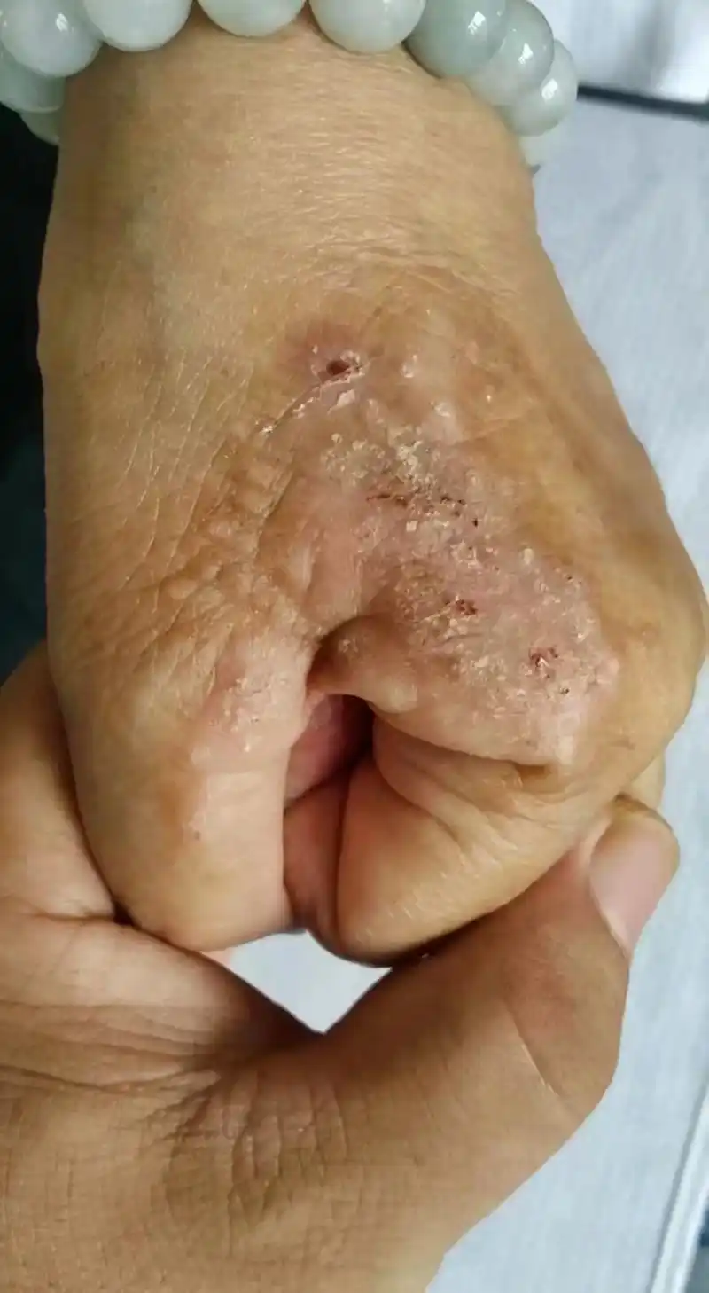 皲裂性湿疹的五个特点 第一个特点:剧烈瘙痒 第二个特点:反 - 抖音