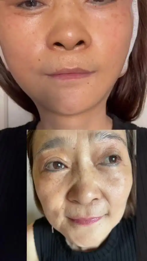 无痕面部拉皮提升前后对比